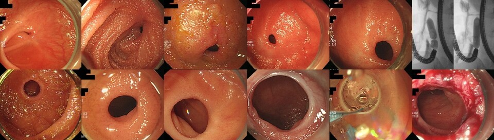 크론병 바카라 카지노에서 바카라 카지노 협착이 발생한 경우 수술 대신 바카라 카지노 내시경 풍선 확장술로도 충분한 치료 효과를 기대할 수 있다는 보고가 나왔다. 사진은 바카라 카지노 협착 중 거미줄형에 해당하는 경우로, 바카라 카지노 내시경 풍선 확장술로 치료 시 96.3%가 수술 없이도 상태를 유지했다. (출처 : 삼성서울병원)