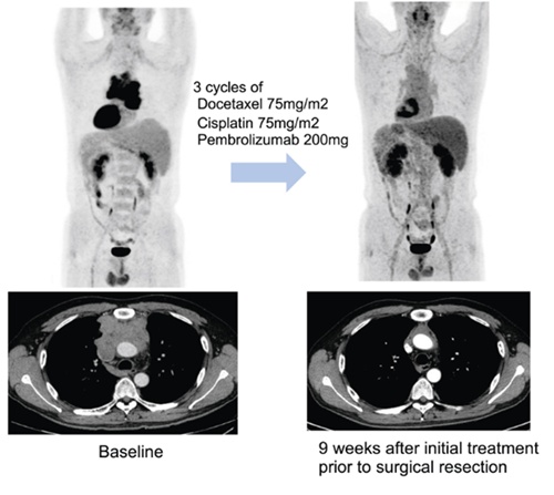 An example of a patient who achieved complete remission (CR) on pathology after receiving three cycles of chemotherapy at three-week intervals combined with the immunotherapy pembrolizumab prior to surgery. According to the research team, this patient was diagnosed with stage 3 thymic carcinoma and has remained recurrence-free for more than three years. The team explained, "Among patients who underwent surgery, approximately 18% achieved CR, and about 46% showed a major pathologic response (MPR), with a residual disease of 10% or less." (Source: Samsung Medical Center)