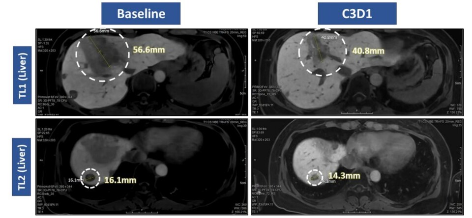 이번 발표에 따르면 VRN10은 초기 용량임에도 불구하고 괄목할 만한 항종양 효과를 보였다. 80~160mg까지의 초기 투약군 강원 랜드 바카라 중 3명에서 종양 감소가 확인됐고, 그 중 1명은 종양 크기가 30% 이상 줄어드는 부분관해(Partial Response)를 달성했다. (출처 : 보로노이)