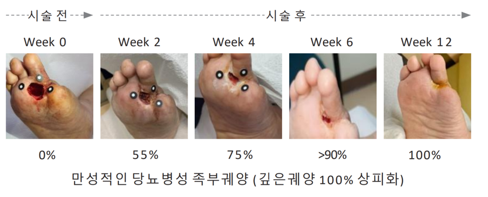 オンラインカジノ登録ボーナス の AI 糖尿病足再生治療プラットフォームの実際の治療プロセスの写真 (出典: オンラインカジノ登録ボーナス)